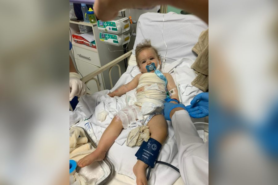 Bebê de 9 meses se recupera de queimaduras graves após acidente