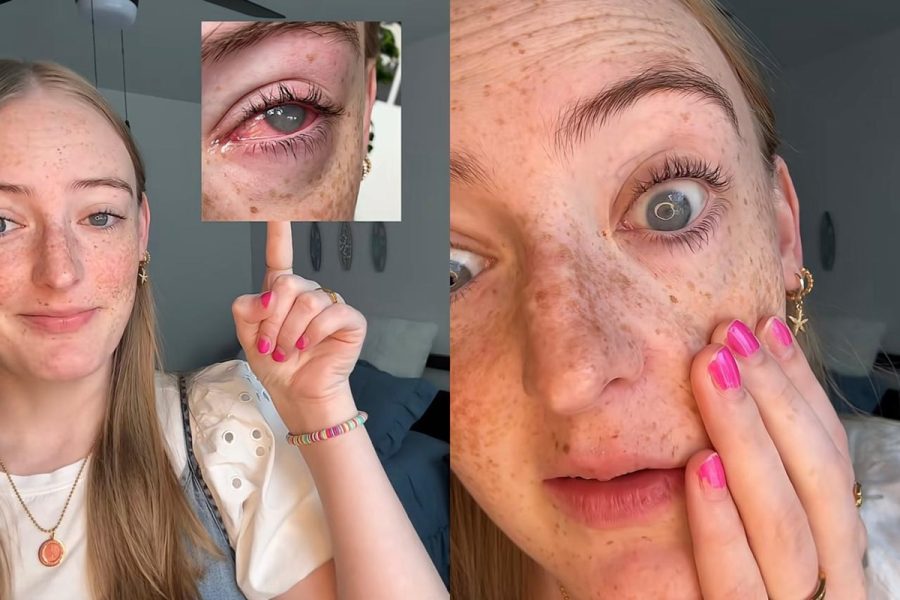 Jovem de 19 anos perde visão após infecção rara por ameba em lentes